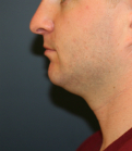 Feel Beautiful - chin implant neck lipo - Before Photo
